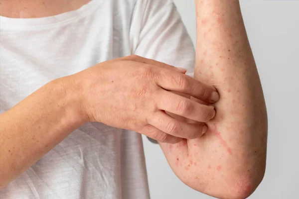Cushing Disease